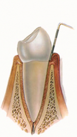 paradontite-sherbime-dentare-paradont-semundje-trajtim-poliklinika-rejuvence